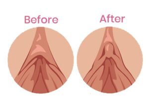 Vaginismus