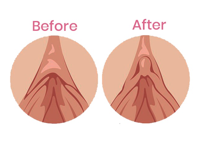 Vaginismus