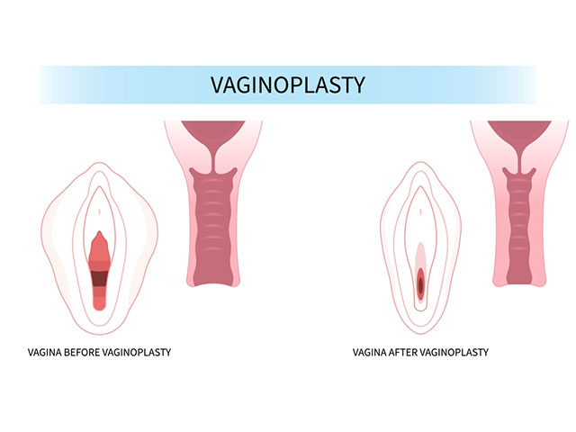 Vaginismus
